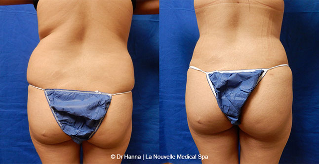 vaser liposuction smartlipo before after photos, Dr. Hanna La Nouvelle Medical Spa, Oxnard, Ventura county  