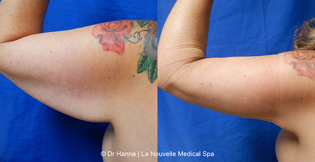 vaser liposuction smartlipo before after photos, Dr. Hanna La Nouvelle Medical Spa, Oxnard, Ventura county  