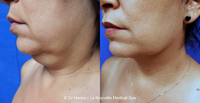 vaser liposuction smartlipo before after photos, Dr. Hanna La Nouvelle Medical Spa, Oxnard, Ventura county  