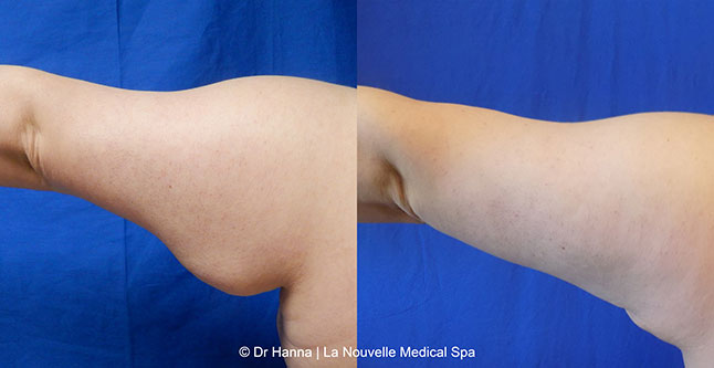 vaser liposuction smartlipo before after photos, Dr. Hanna La Nouvelle Medical Spa, Oxnard, Ventura county  