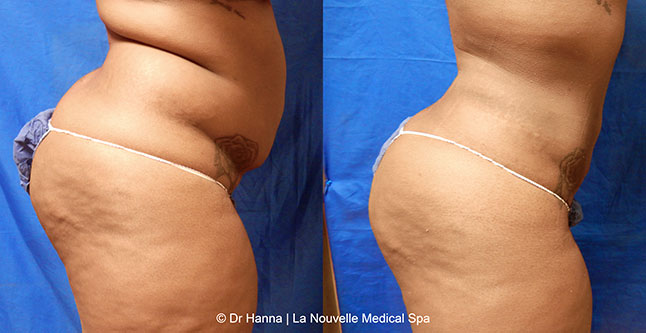 vaser liposuction smartlipo before after photos, Dr. Hanna La Nouvelle Medical Spa, Oxnard, Ventura county  