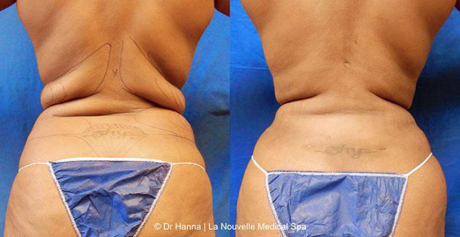 vaser liposuction smartlipo before after photos, Dr. Hanna La Nouvelle Medical Spa, Oxnard, Ventura county  