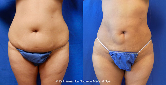 vaser liposuction smartlipo before after photos, Dr. Hanna La Nouvelle Medical Spa, Oxnard, Ventura county  