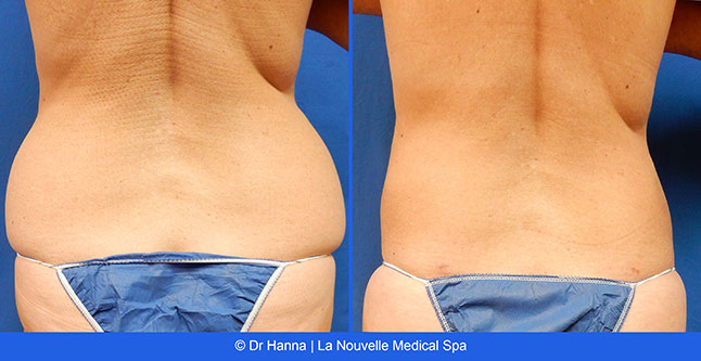 vaser liposuction smartlipo before after photos, Dr. Hanna La Nouvelle Medical Spa, Oxnard, Ventura county  