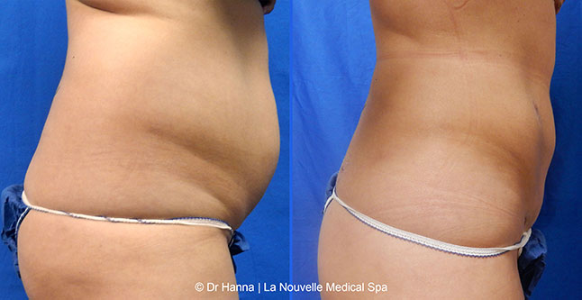 vaser liposuction smartlipo before after photos, Dr. Hanna La Nouvelle Medical Spa, Oxnard, Ventura county  