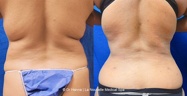 vaser liposuction smartlipo before after photos, Dr. Hanna La Nouvelle Medical Spa, Oxnard, Ventura county  