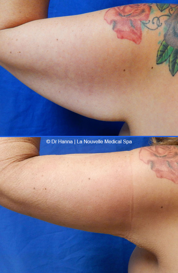 liposuction on back by dr hanna la nouvelle spa oxnard