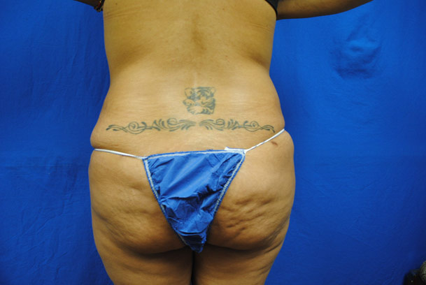 liposuction-ventura-county-female-back-before-by-dr-hanna-la-nouvelle-medical-spa