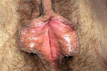 labiaplasty before