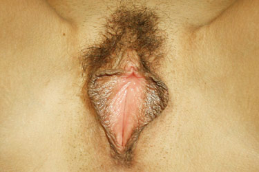 labiaplasty before